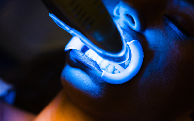 Branqueamento Dentário: verdades e mitos