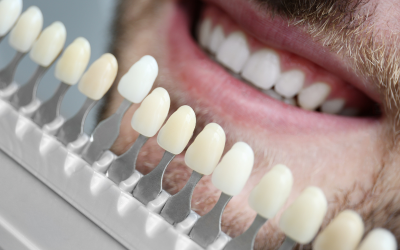 Facetas Dentárias como solução?