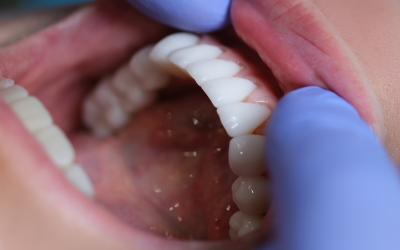 Doenças Periodontais