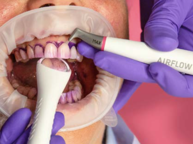 GBT – Guided Biofilm Therapy: higiene oral sem desconforto