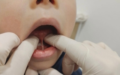 Freio da Língua (Língua Presa): Avaliação e Impacto na Amamentação, Fala e Respiração