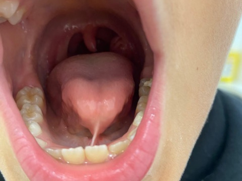 am smiling<br />
freio da língua<br />
língua presa