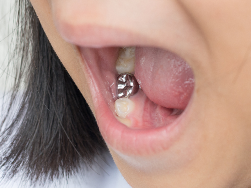 Amálgamas dentárias: devo remover os “chumbos” que ainda tenho nos dentes?